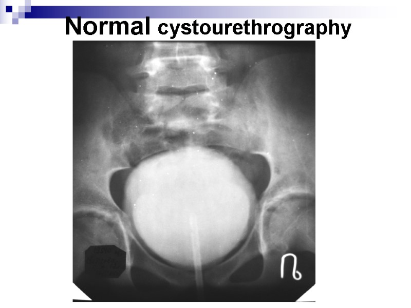 Normal cystourethrography